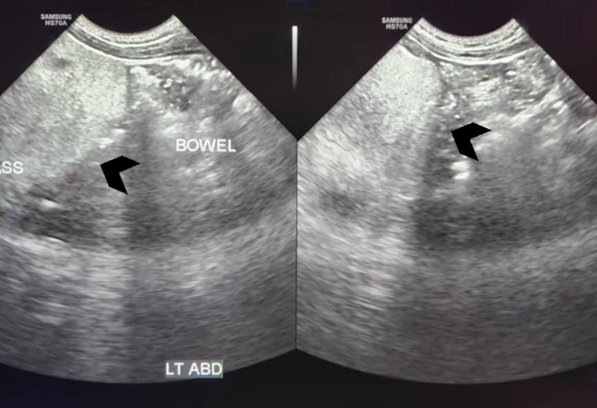 Abdominal ultrasound showed a large lobulated hyperechoic mass occupying abdomen and pelvis (black arrowhead)