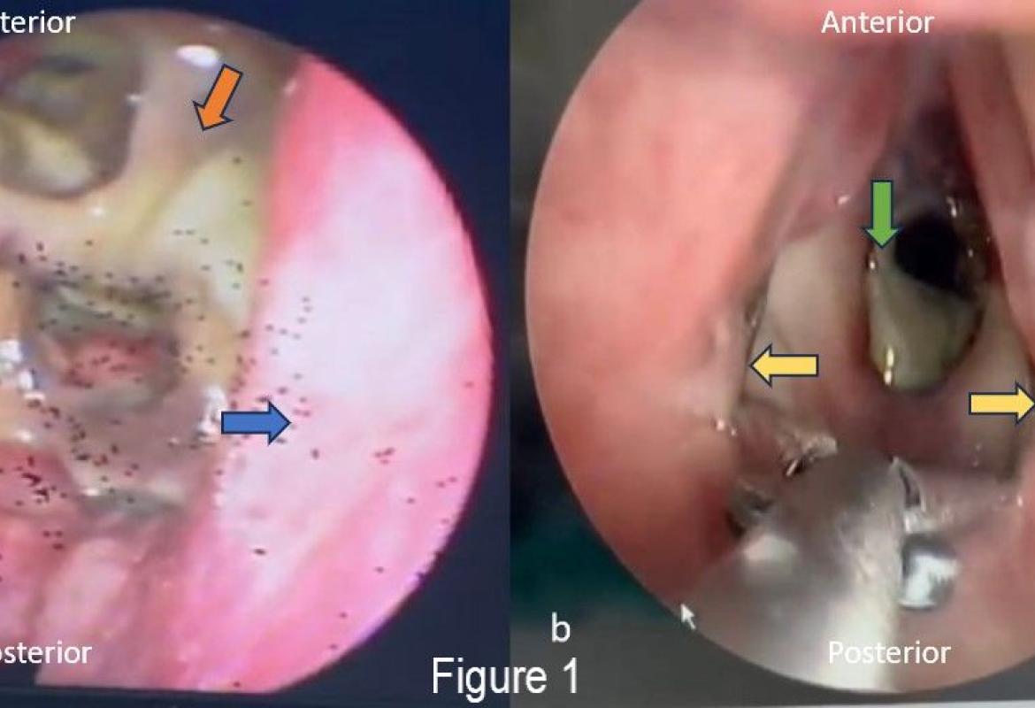 (a) Bedside FNPLS of subglottic view, revealed thick greenish mucopus at the subglottis and slough within necrotic tracheal mucosa (orange arrow), blue arrow showed right wall subglottic area; (b) Direct laryngoscopy with laryngeal spreader lateralising bilateral true cords (yellow arrow) showing that there was a necrotic segment of the trachea (green arrow) which then removed.