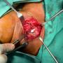 FIGURE 1: Neck re-exploration revealing intact suture at the site of primary repair