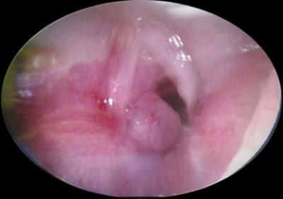 Figure 1: Endoscopic photograph of the larynx showing a subglottic cyst at left posterior commissure with subglottic oedema