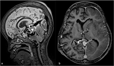 Figure 1: MRI of the brain in sagital T2WI and contrast-enhanced T1 MPRAGE demonstrate multiple serpiginous flow voids (star and bent arrow) representing dilated venous channels. Abnormal vessels (bent arrow) are seen draining into a dilated vein (thin arrow), which in turn drains into the superior sagital sinus. Narrowing of aqueduct of sylvius is marked with an arrowhead.