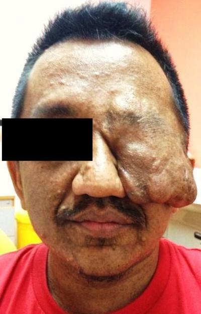 Figure 1: Left facial tumour protruding from the orbital cavity displacing the eyeball downwards (eyeball not seen in picture) 