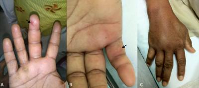 Figure 1: Acute presentation of the bitten area by a Thelcticopis sp. spider (A) The bite mark and swelling of the right middle finger; (B & C) The bite mark with surrounding hyperemia and swelling of the hand prior to the administration of medication in the emergency department.