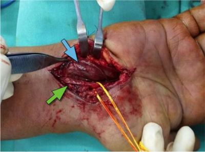 Figure 1: Hypertrophic first lumbrical muscle (blue arrow) and second lumbrical muscle (green arrow) compressing on the median nerve (deep to the lumbrical muscle).