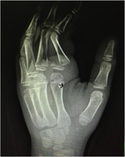 Figure 1: Radiograph of the left hand showing a displaced and angulated fracture of the base of the proximal phalanx of the left index finger (Salter Harris Type 2) (yellow arrow)