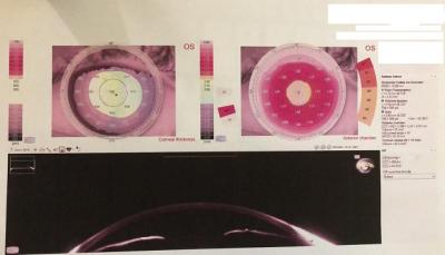 Figure 1: Sirius Scheimpflug -Topographer results page of a patient