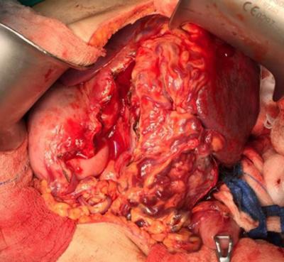 Figure 1: A hard nodular mass at the hilum of spleen with dilated tortuous vessel