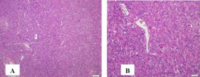 Figure 1: Images showing histologic features of solitaru fibrous tumour (A) with hypocellular and hypercellular pattern; (B) with haemangiopericytoma like vessels