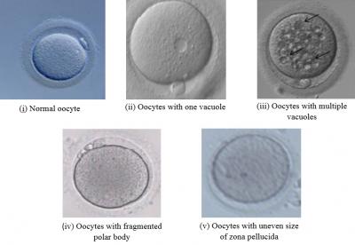 Figure 1: The photomicrograph of normal and abnormal morphology in oocytes retrieved from young and aging mice (100x magnification). (i) oocyte with normal morphology: with the presence of a polar body and evenly-sized zona pellucida (ii - v) oocytes with abnormal morphology: with the uneven size of zona pellucida, the appearance of one or multiple vacuoles, and a fragmented polar body.  