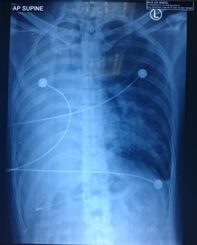 Figure 1: CXR post-intubation before any bronchoscopy and suctioning intervention. Right lung atelectasis and shifting of trachea towards right lung noted.