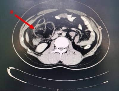 Figure 1: CT abdomen showed dilated loop of terminal ileum at right iliac fossa with fecal intraluminal appearance suggestive of sub-acute bowel obstruction (a) with free air at superior aspect of this loop (b) as well with free fluid seen in right paracolic gutter (c).