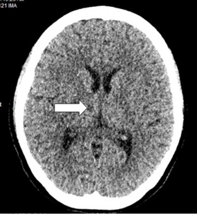 Figure 1: Non contrast Computed Tomography shows hypodensity at the right thalamus shown in white arrow