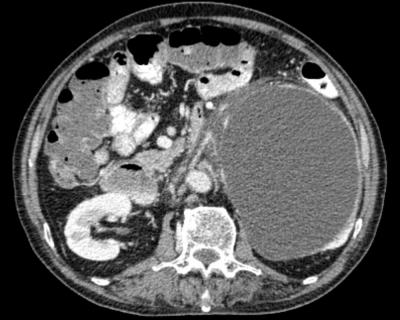 Figure 1: Contrasted computed tomography showing huge left homogenous and regular retroperitoneal lesion with peripheral enhancement on axial view