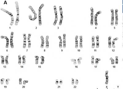 Figure 1: G-banded karyotype of the patient showing double aneuploidies in his karyotype. (A) monosomy X (45,X) and (B) trisomy 21 (47,XY,+21) (C) Karyotype of a normal male for comparison