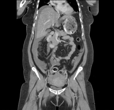 Figure 1: Free fluid noted in the pelvis, perihepatic region, perisplenic region and along the para-colic gutter.