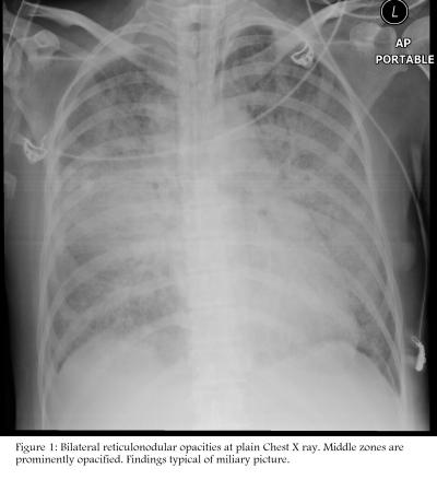 Figure 1: Bilateral reticulonodular opacities at plain chest x-ray. Middle zones are prominently opacified. A typical findings of miliary picture.