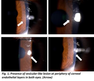 Figure 1: Presence of vesicular-like lesion at periphery of corneal endothelial layers in both eyes (arrow)