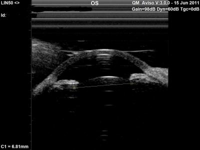 Figure 1: Crystalline lens and anterior segment axial cross-section as captured by the Quantel Aviso UBM 50Mhz probe