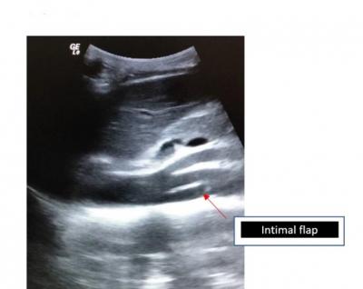 Figure 1: Bedside USG Abdomen in ED shows visualization of an intimal flap (red arrow)