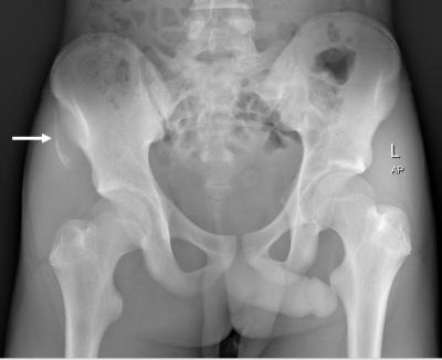 Figure 1: Plain pelvis radiograph showing avulsion fracture of right anterior superior iliac spine (white arrow).