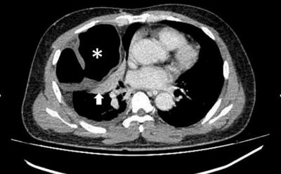 CT in axial view at the level of thorax with evidence of herniated bowel loop into the right thoracic cavity (*) complicated with collapse consolidation of the adjacent lung (arrow)