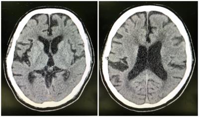 Figure 1: Plain CT brain image of the patient