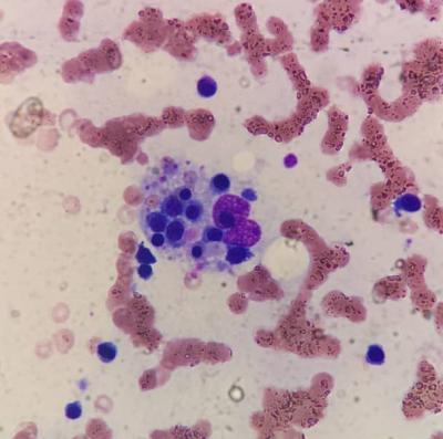 Figure 1: Bone marrow aspiration shown histiocyte with prominent haemophagocytic activity (May-Grünwald-Giemsa stain, magnification 400x).