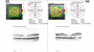 Figure 1: Figure shows a typical OCT scan of a patient with DR and non- centre involving DME