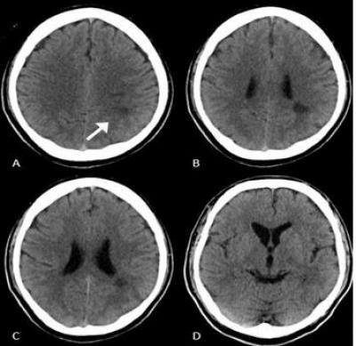 Figure 1: Non-contrast CT brain showing a hypodensity on the A:left mid-parietal region (white arrow), B & C: hypodensity of the left angular gyrus, D: loss of sulci and gyri indicates cerebral edema, which is consistent with left middle cerebral artery territory infarct.