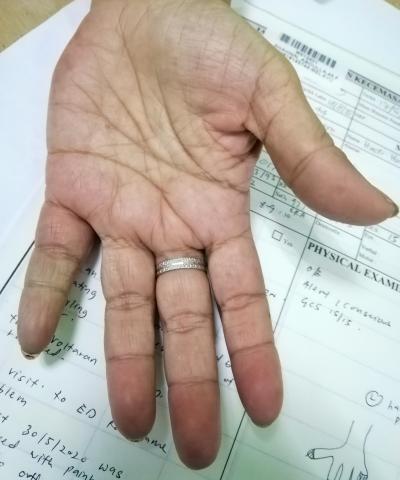 Figure 1: Mild cyanosis over left fifth finger