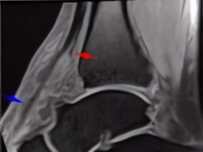 Figure 1: Sagittal T1 fat suppresion image of the ankle showed tear of the TA tendon at the level of distal tibial (red arrow) with the remaining tendon exhibited high signal intensity (blue arrow) till its insertion to the navicular base.