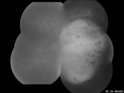 Figure 1: OS fundus showed vitritis with a huge dome-shaped choroidal mass covering the whole macula