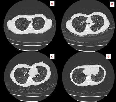 Figure 1: HRCT Thorax (A-D) showed bilateral diffuse cytic lesions of varying sizes