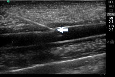 Figure 1: Ultrasonographic image of phantom vessel cannulation using the in-plane approach, with the simulated vein (v) in longitudinal view, and the needle tip (arrow) indenting the vessel wall.
