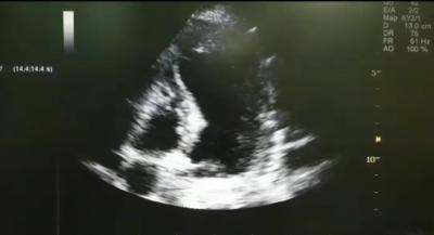 Bedside echocardiogram showed dilated left ventricle (LV) on a apical 4-chamber view.