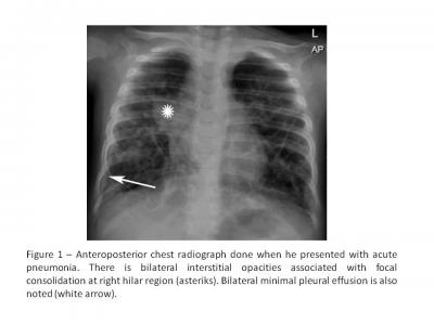 Figure 1: Anteroposterior chest radiograph done when he presented with acute pneumonia. There is bilateral interstitial opacities associated with focal consolidation at right  hilar region (*). Bilateral minimal pleural effusion is also noted (white arrow)